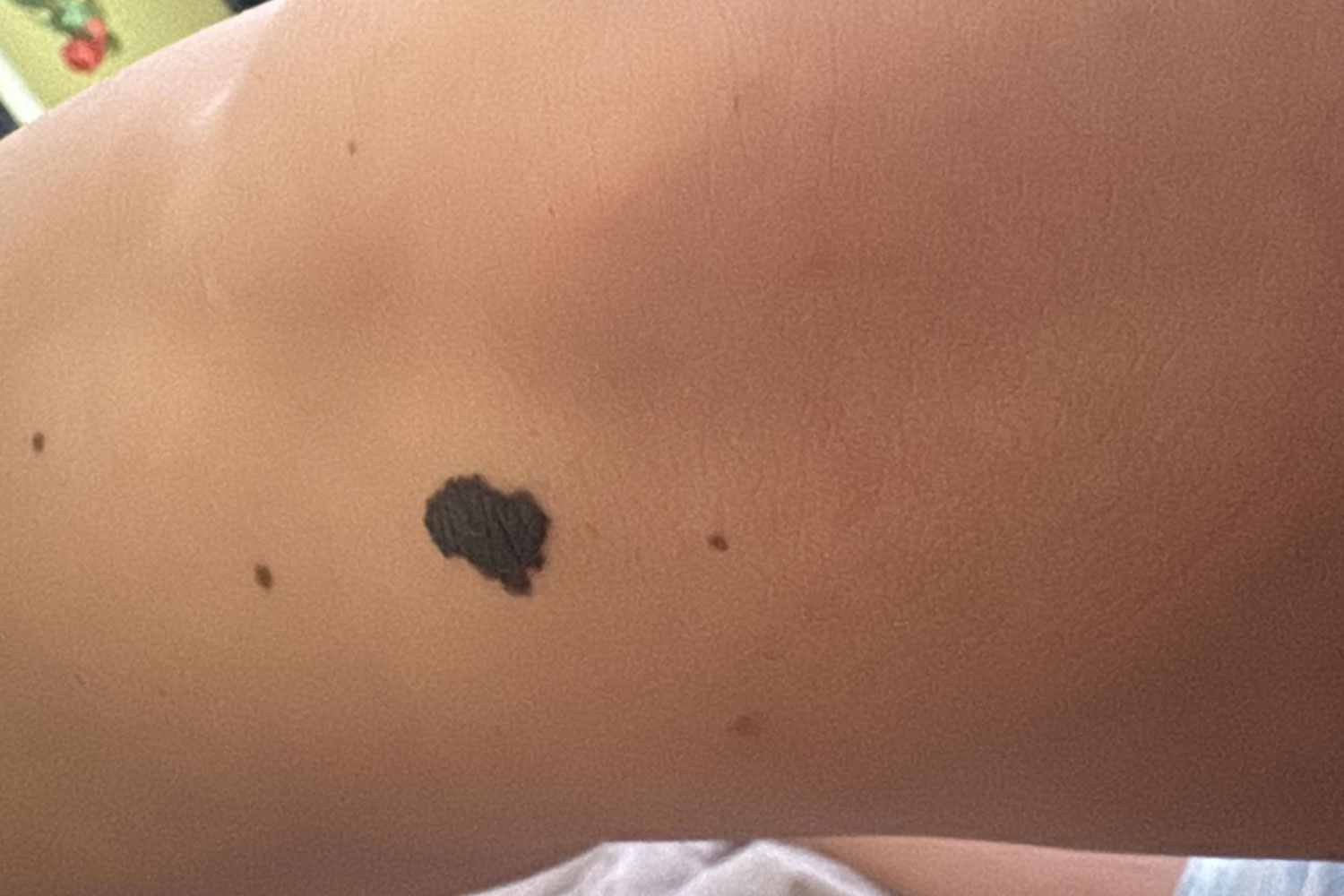 Melanoma, il nemico silenzioso che si può battere: la forza della diagnosi precoce